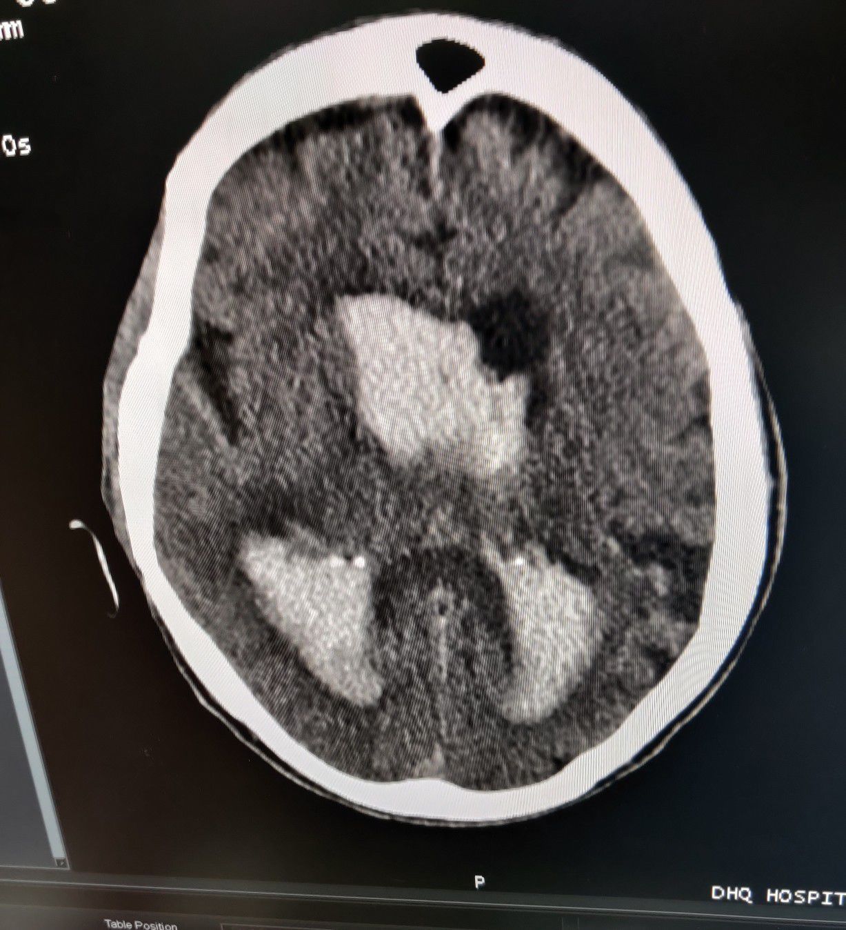 Hemorrhagic CVA - MEDizzy