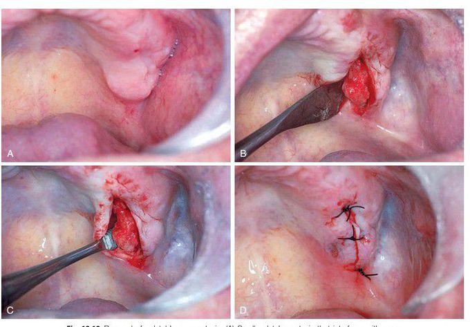 Removal of palatal bony exostosis