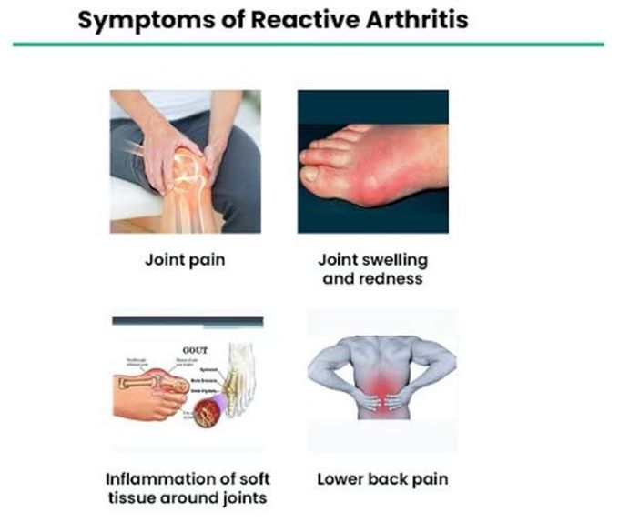 These are the symptoms of Reactive Arthritis syndrome