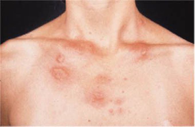 Cat Scratch Disease MEDizzy
