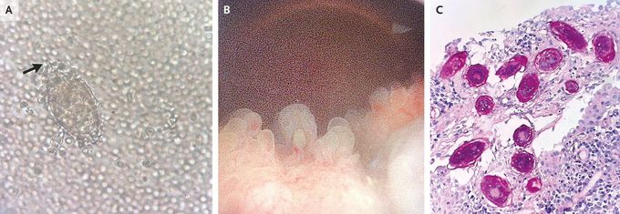 Urinary Schistosomiasis