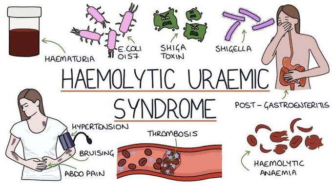 Hemolytic uremic syndrome