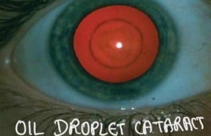 Oil Droplet Cataract