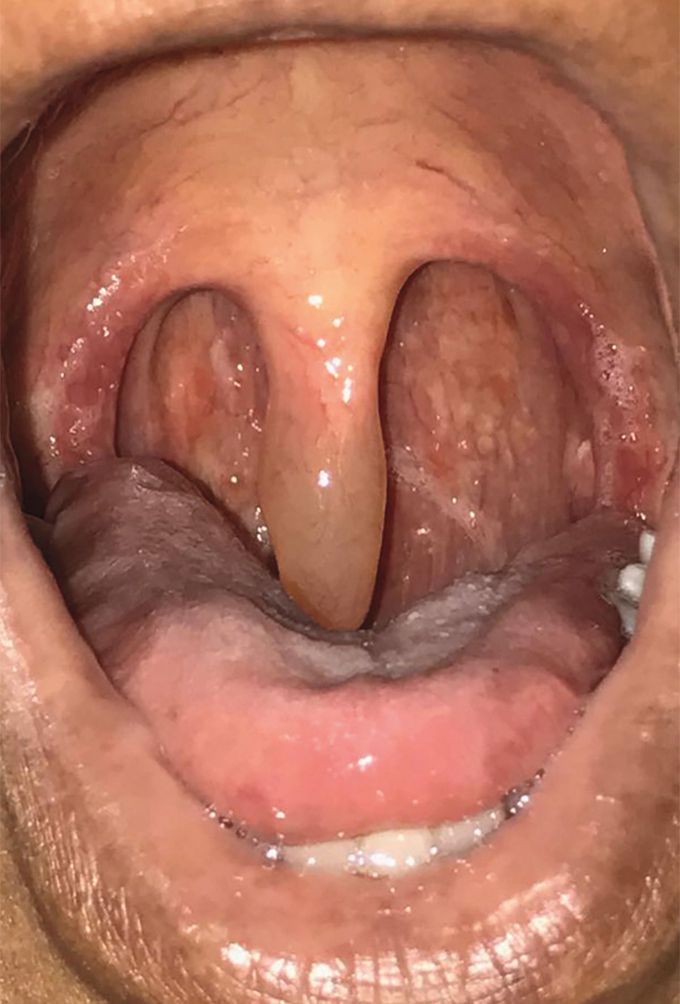 Uvula Amyloidosis