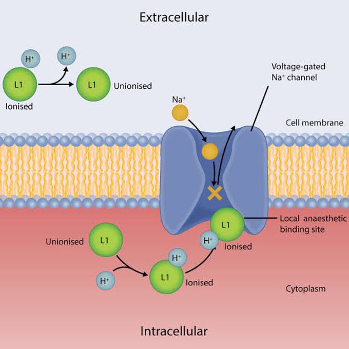 Mechanism of action of local anesthesia