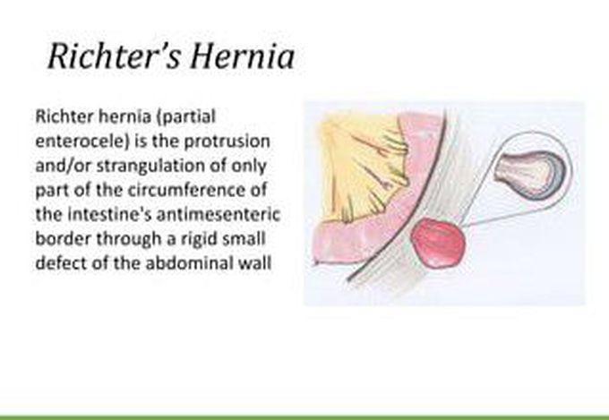 Symptom of Richter Hernia