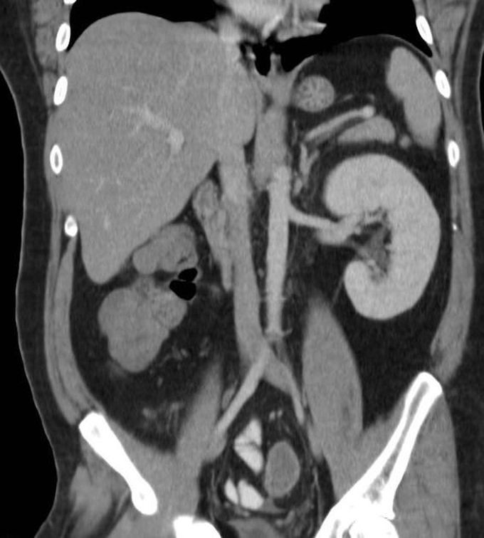 Renal Agenesis