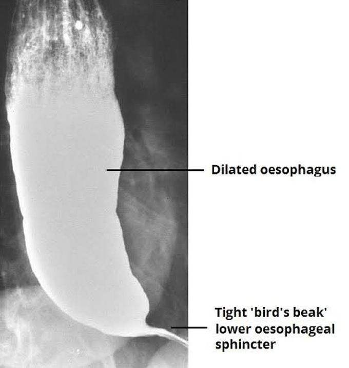 Causes of achalasia