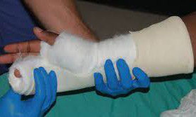 Ulnar gutter cast