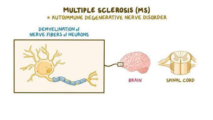 Multiple sclerosis