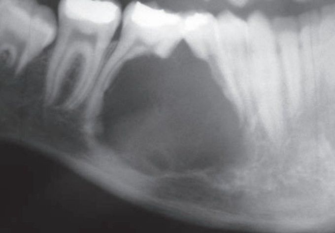 External resorption