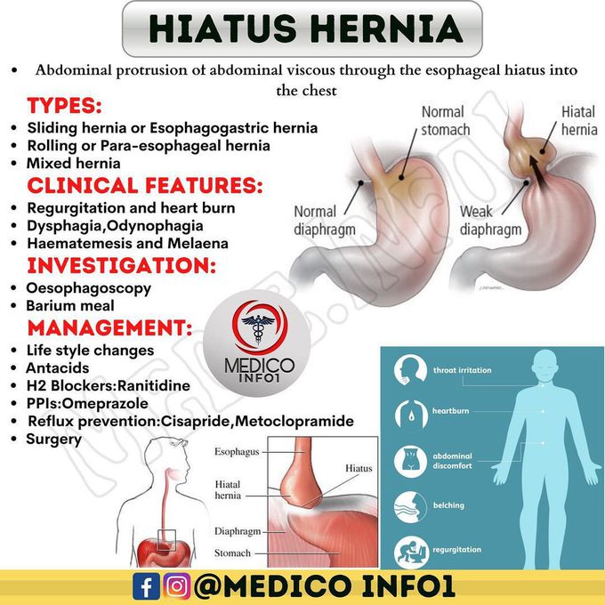 Hiatus Hernia