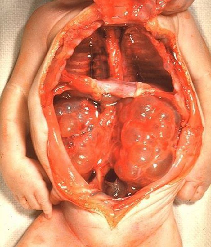 Multicystic dysplastic kidney