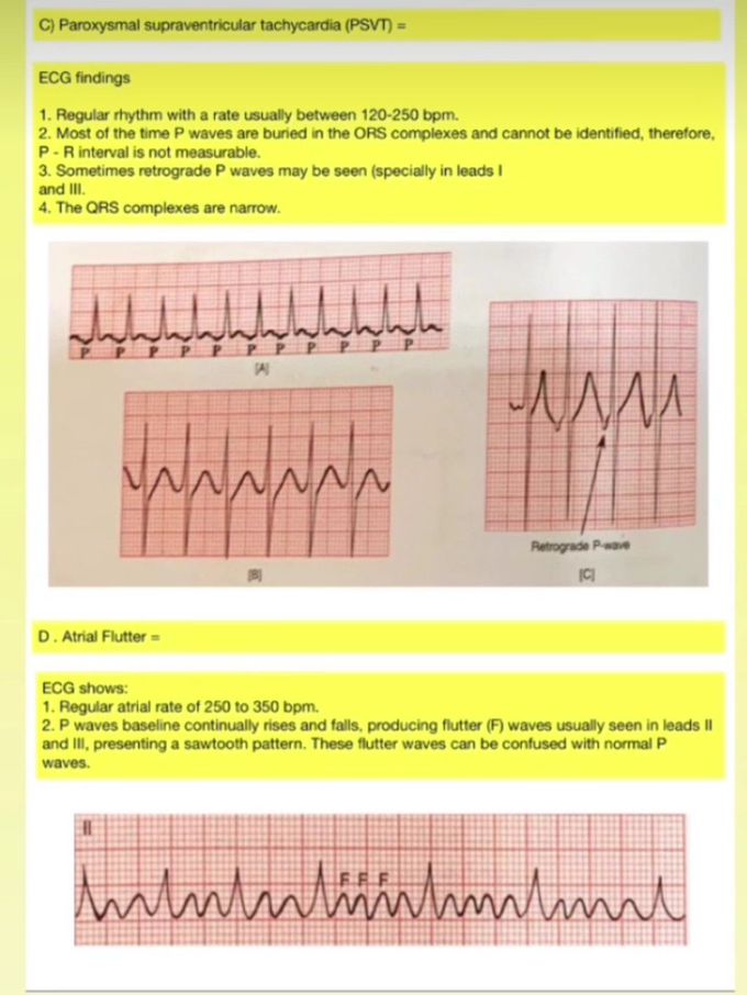 PSVT and Atrial Flutter