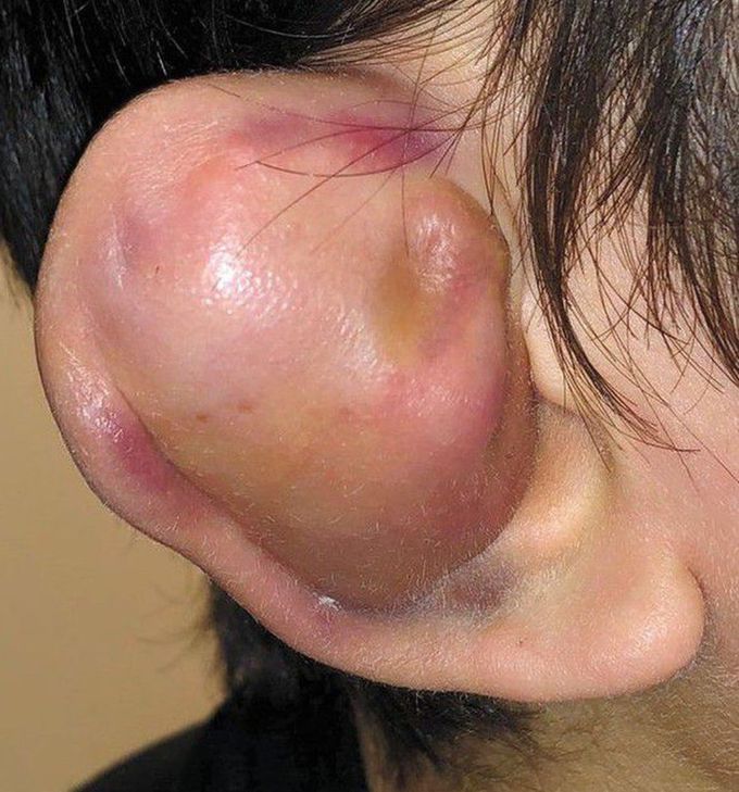Auricular Hematoma