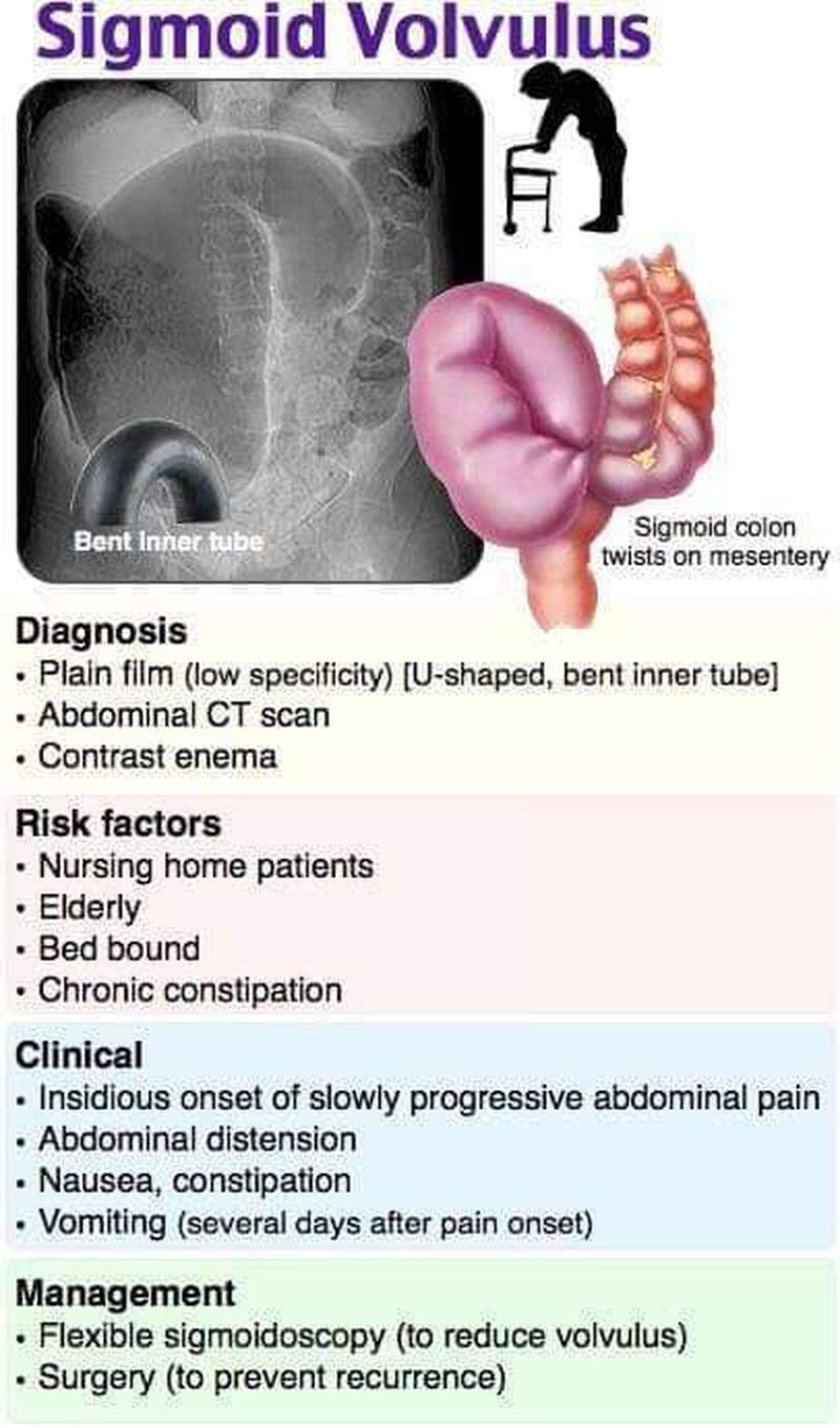 Sigmoid Volvulus MEDizzy