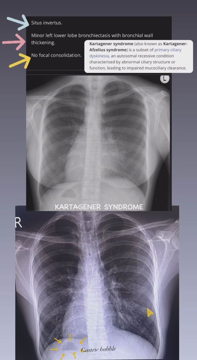 Kartagener Syndrome