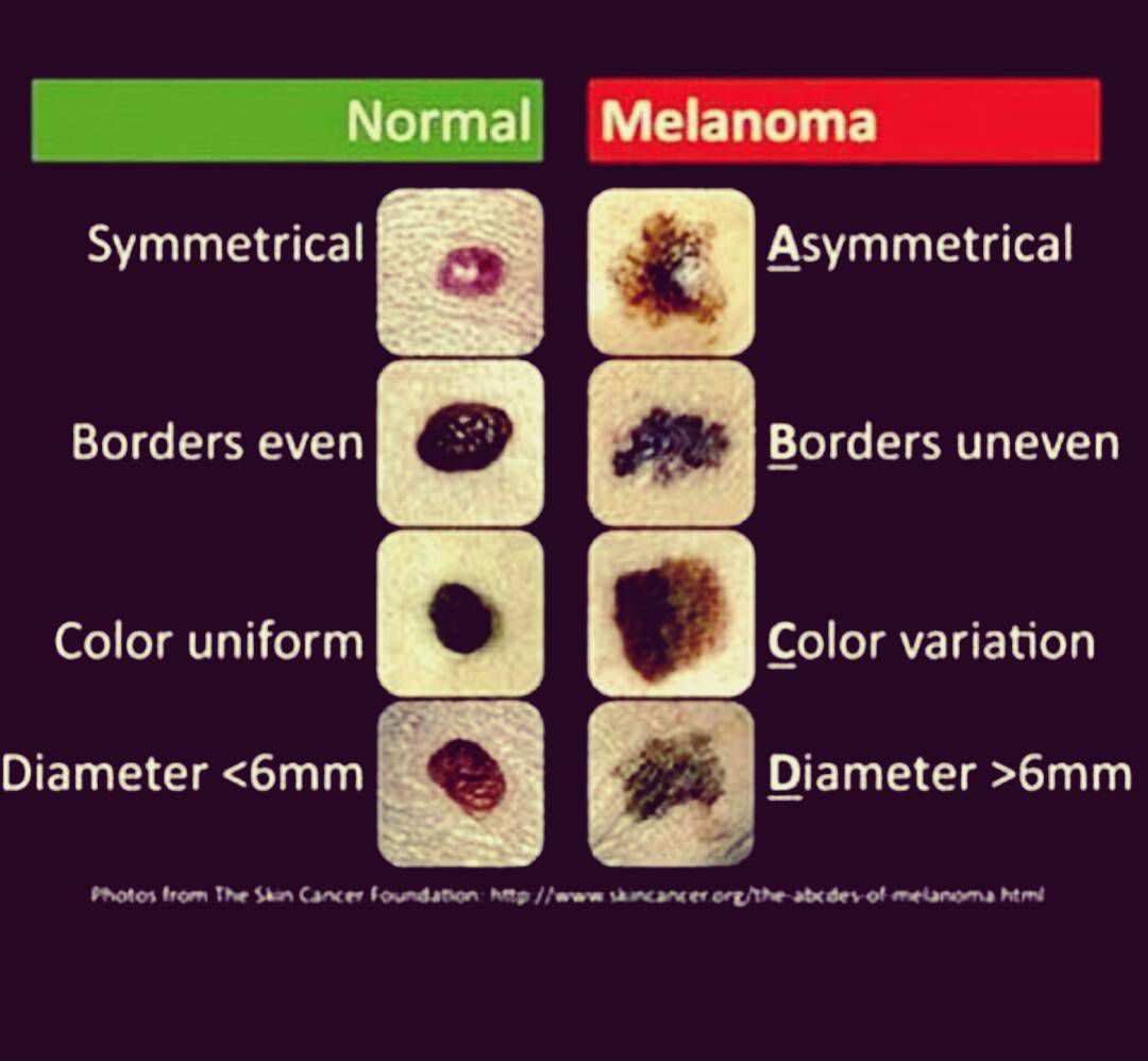 cancerous moles vs normal moles