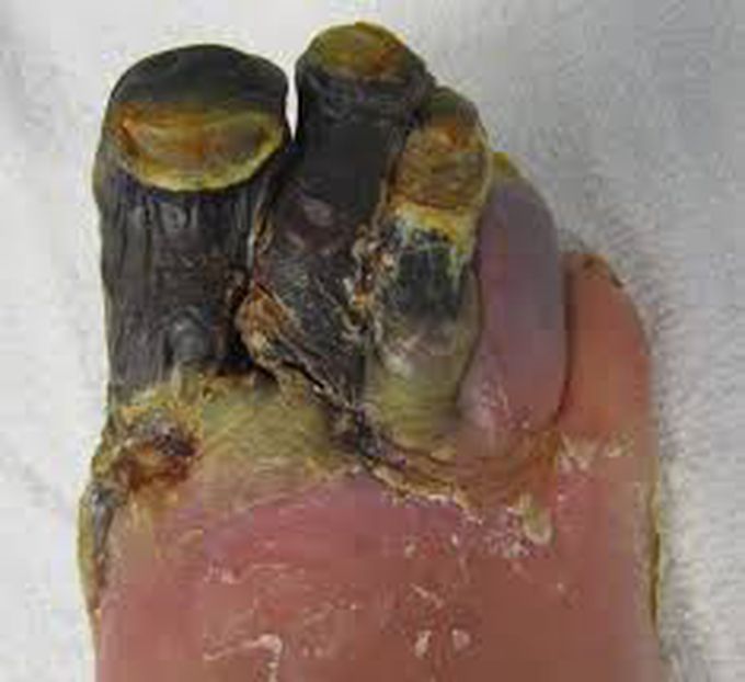 causes of gangrene