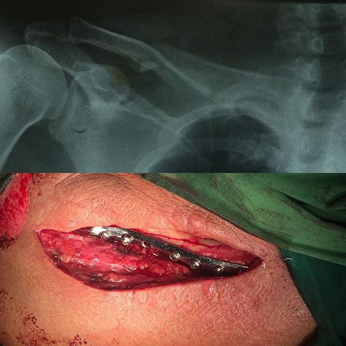 Clavicle fracture