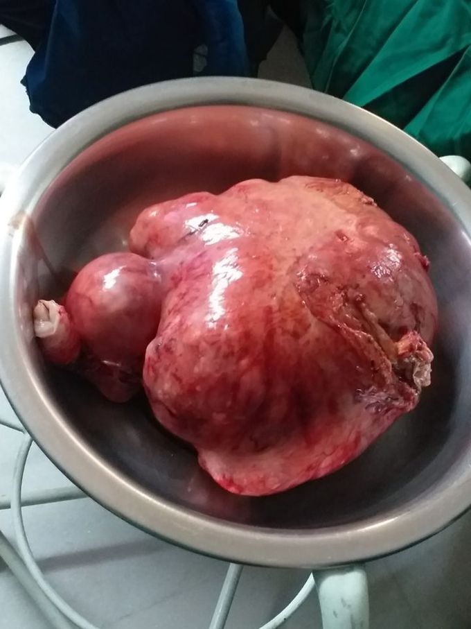 A uterine mass ( fibroid )