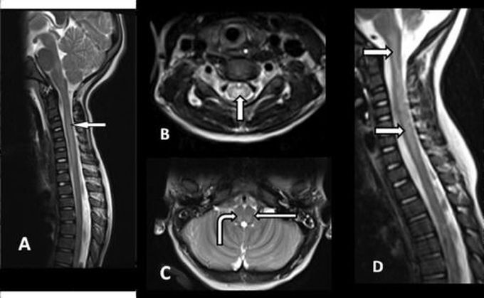 Acute Flaccid Myelitis