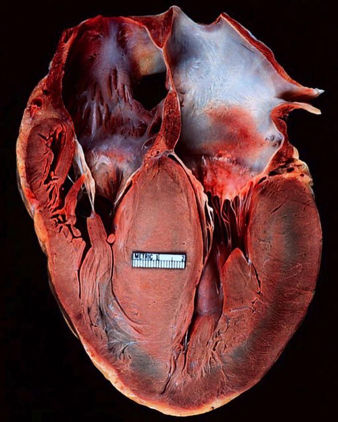 Hypertrophic cardiomyopathy