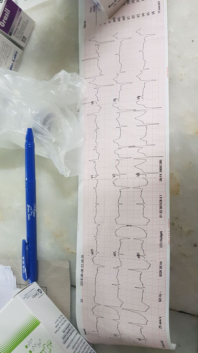 Ecg interpretation of post op mvr