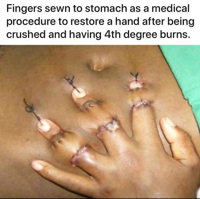 Finger sewn to stomach!!!