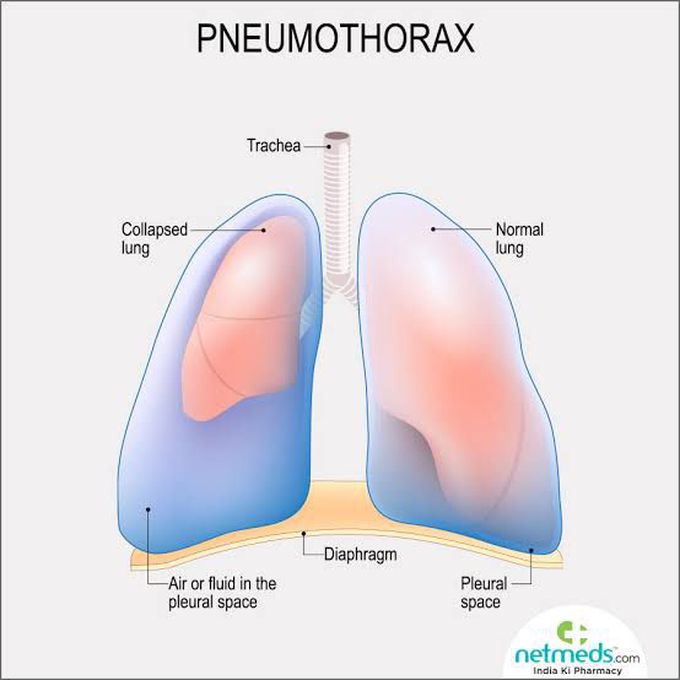 Pneumothorax