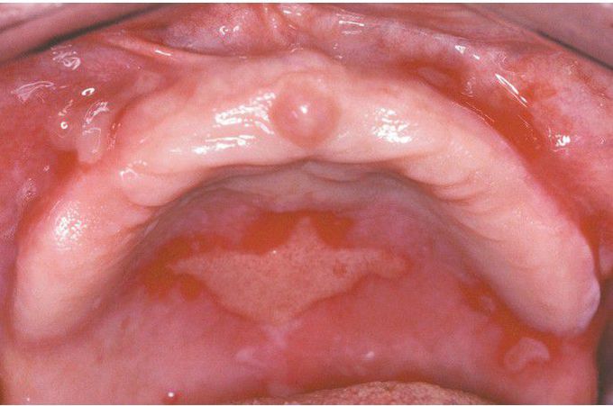 Mucous Membrane Pemphigoid