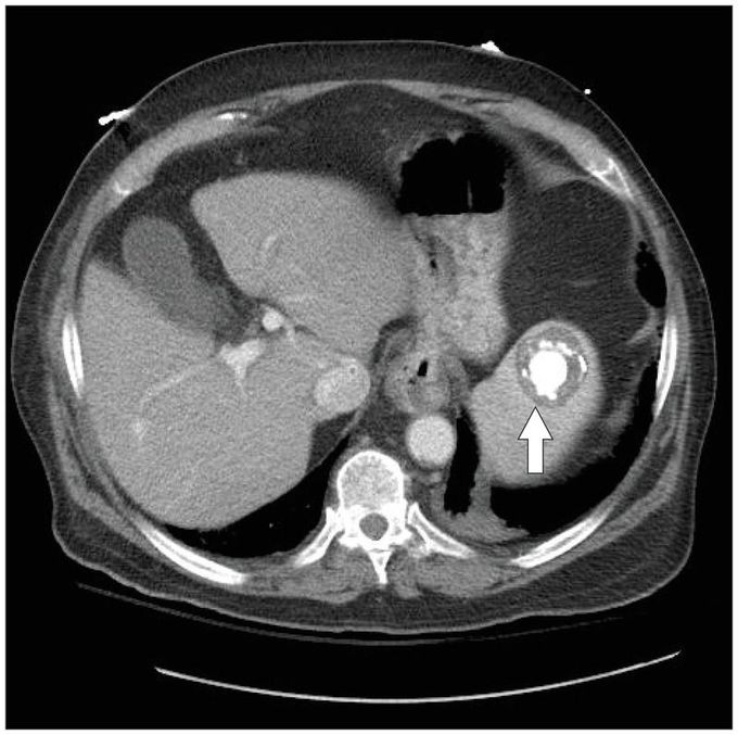 Chronic Splenic Brucellosis