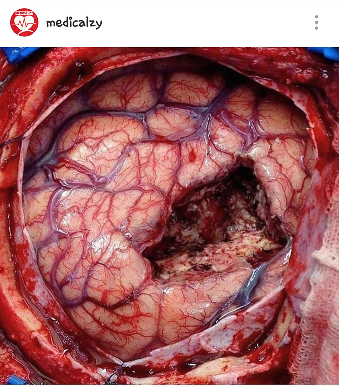 Brain tumour removed.