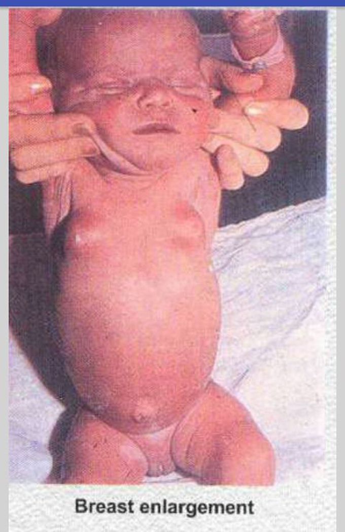 Normal Neonatal Gynecomastia