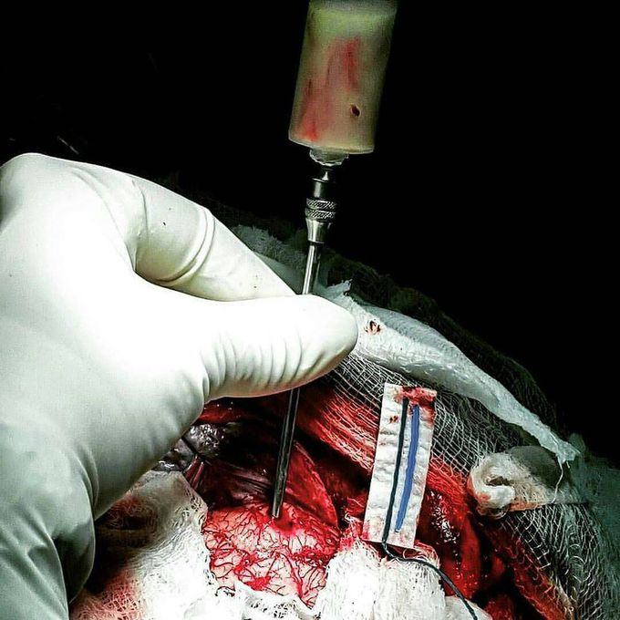 Brain abscess drinage 