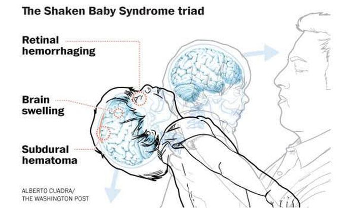Risk factors of shaken baby syndrome