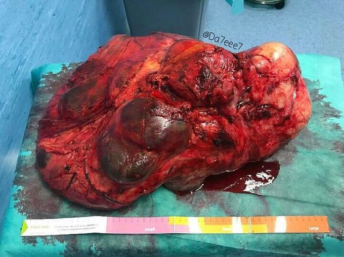 Retroperitoneal Mass