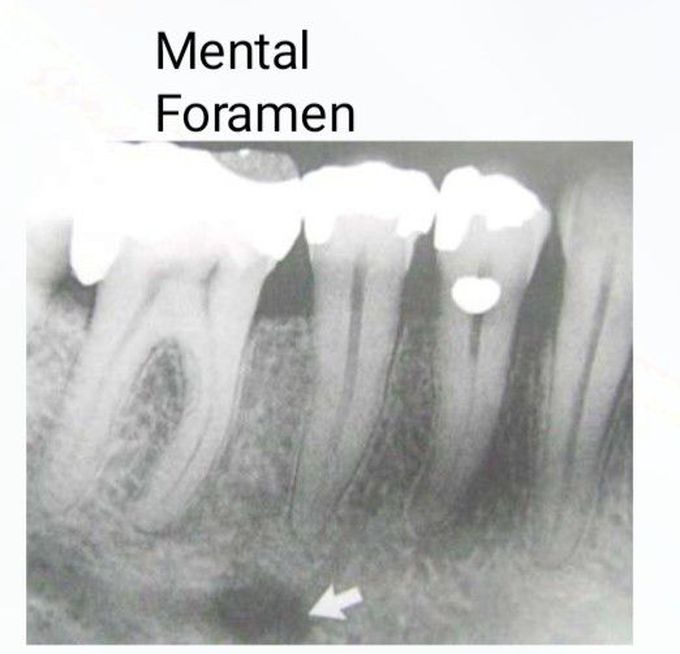 Mental Foramen