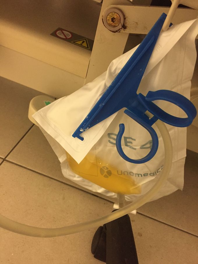 “A dark yellow’s Paul “ what is your diagnosis ???