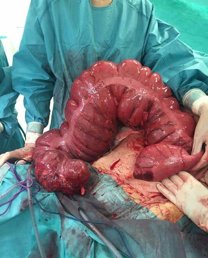 Ogilvie's Syndrome