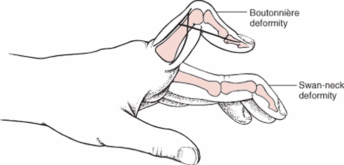 Boutonniere Deformity