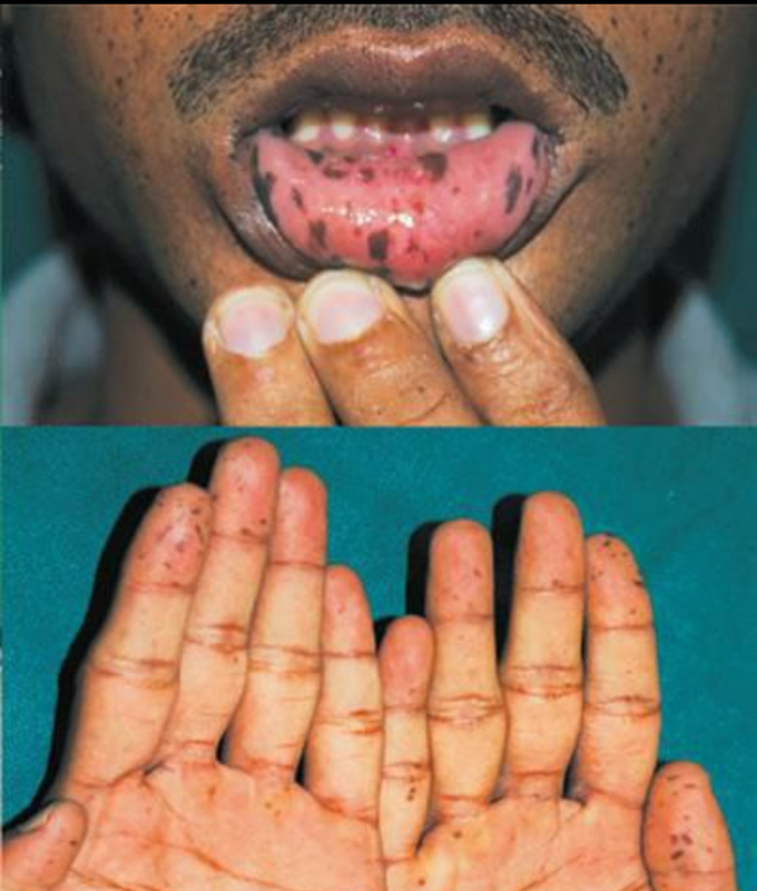 A 20 aged boy came to hospital with history of melena ,abdominal pains and has pigmentation of lips what is the dignosis& disease ?????