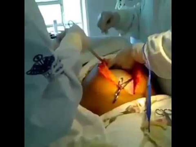 Extraction of a giant ovarian tumor