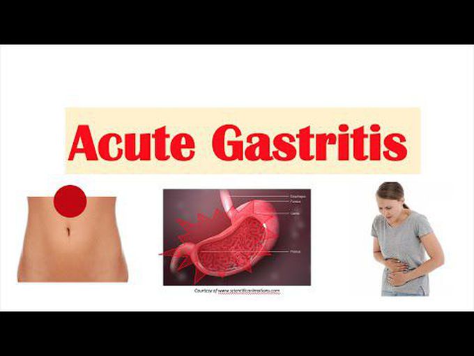 Acute Gastritis: Introduction