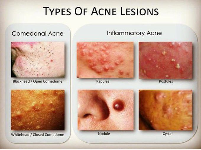 DIFFERENT TYPES OF ACNE LESIONS