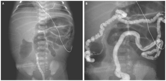 Meconium Ileus in a Neonate with Cystic Fibrosis