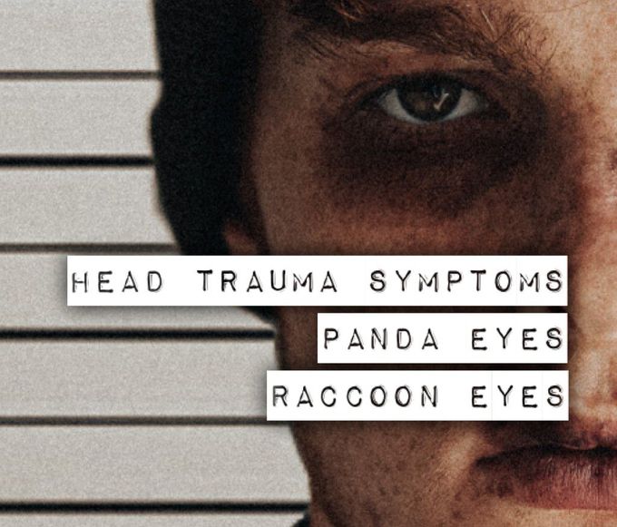 Symptoms of Panda eye