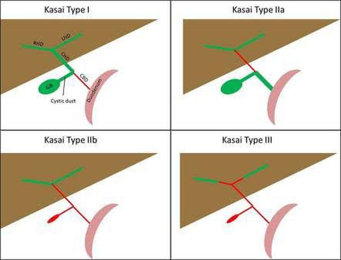 Biliary Atresia Classification