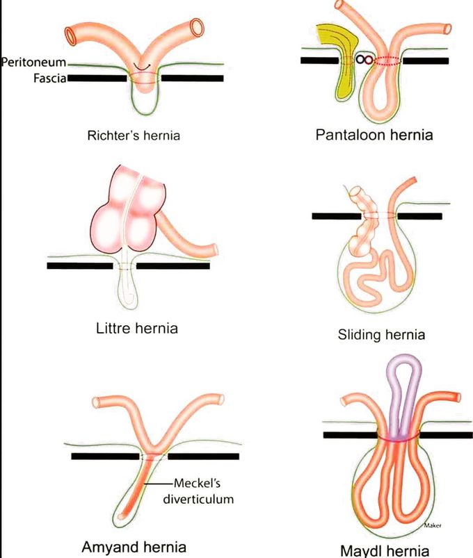 Types of Hernia