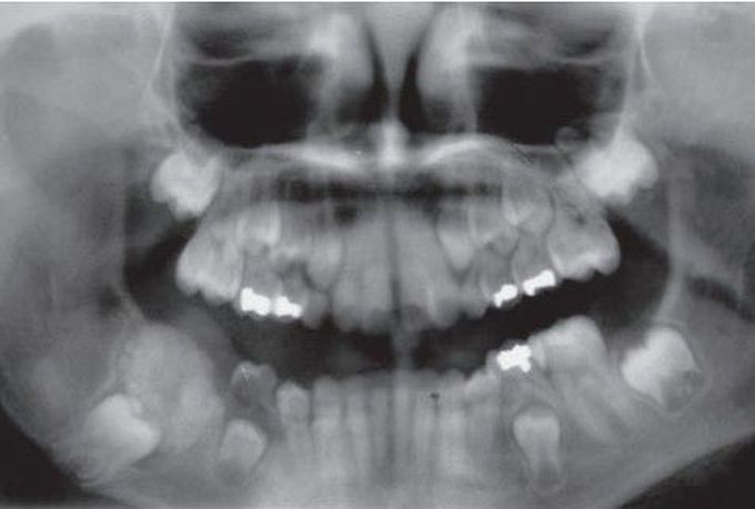 Odontoma radiograph